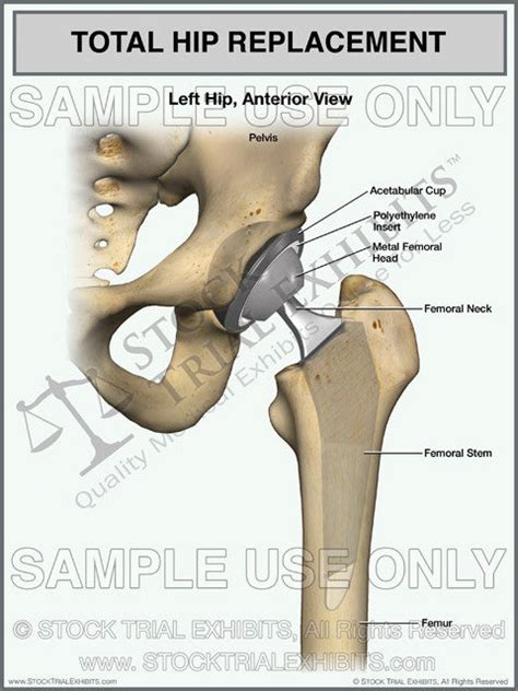 icd 10 left total hip arthroplasty